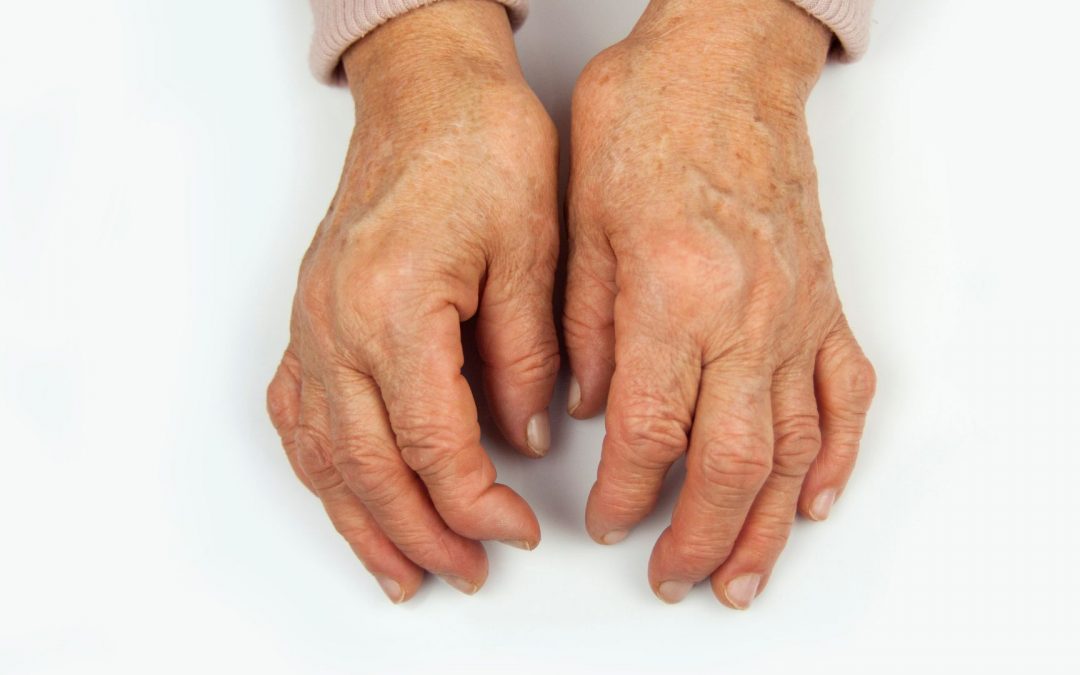 Keto and Fasting For Rheumatoid Arthritis